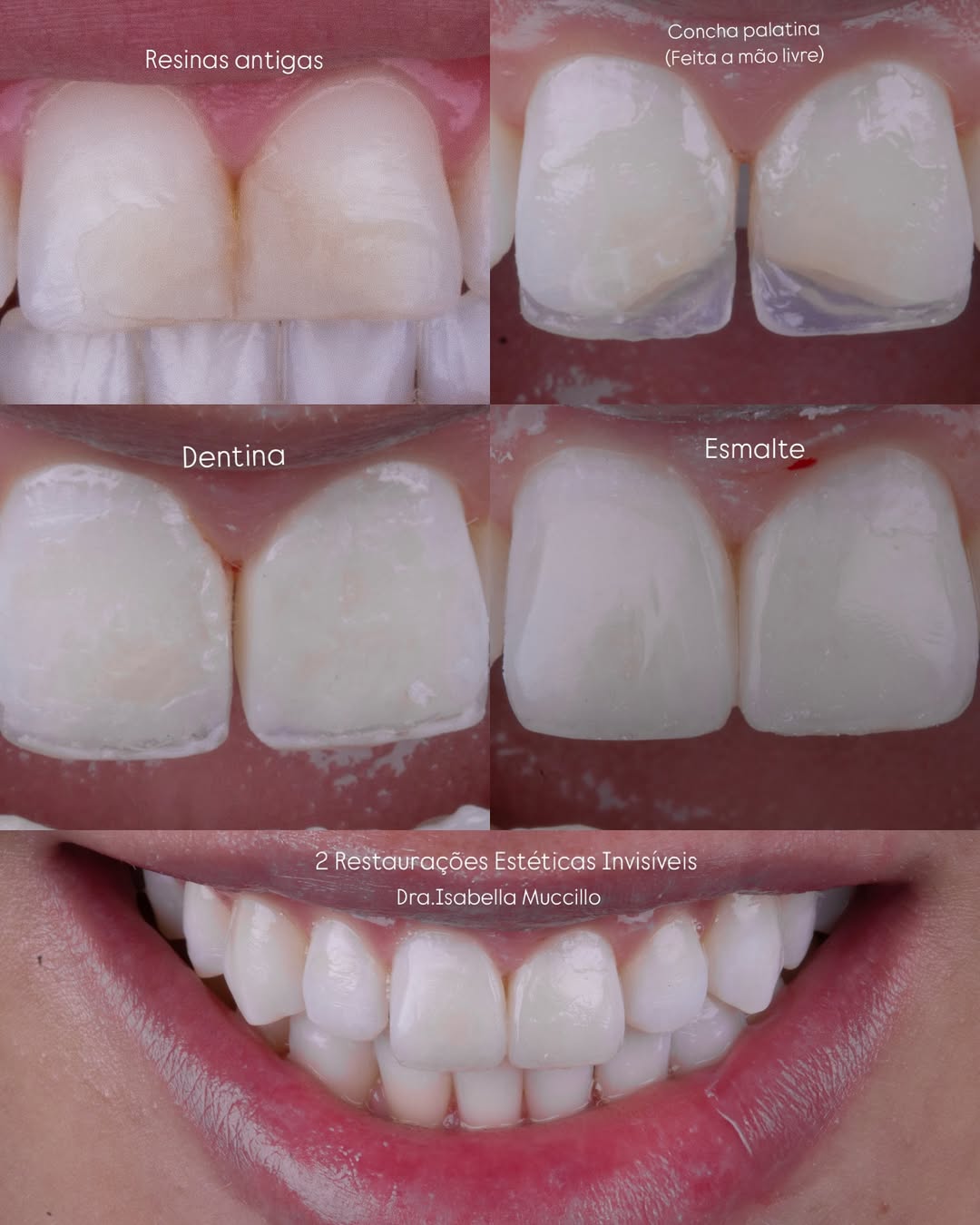 Fechamento de Espaços (antes e depois)